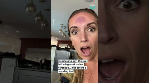 Suction Cup On Forehead Leaves Big Mark || ViralHog